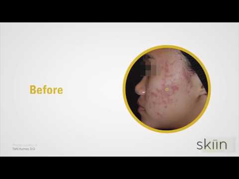  Laser Genesis Explained   - Medaesthetics