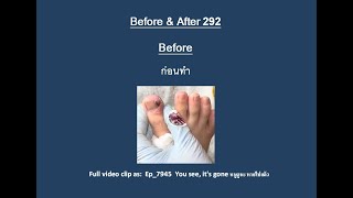 BA_292 Before and After 👣 มาดูแผลเล็บขบหลังจากน้องมาทำกับพี่เอื้อม 😷 (Ep_7945)