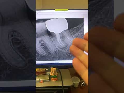 Don’t use Gates Glidden drills!