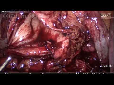 Laparoscopic pyeloplasty part 2 ANASTOMOSIS OF THE UPJ