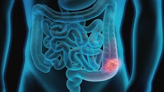 Bowel Obstruction #small bowel obstruction #surgery #shorts