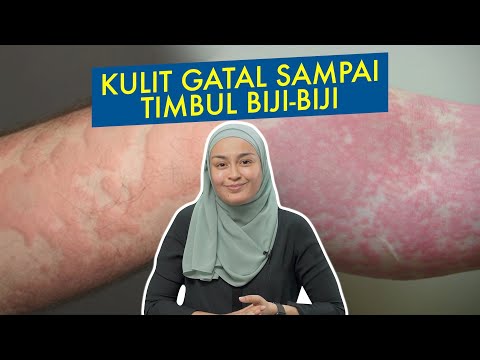 , title : 'Kulit Gatal Sampai Timbul Biji-Biji'