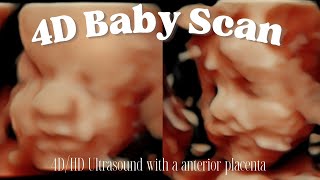 Our 4D Baby Scan | HD Ultrasound With AN Anterior Placenta | 28 Weeks Pregnant | Third Trimester