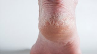 How to Get Rid of Dry Cracked Feet - Dry Cracked Heels Remedy
