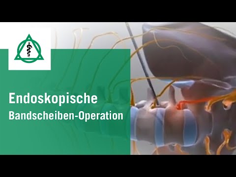 , title : 'Endoskopische Bandscheiben-Operation | Asklepios'