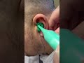 Part Two Take The Impression Audiologist Earwax Satisfying Asmr Earimpression Audiology