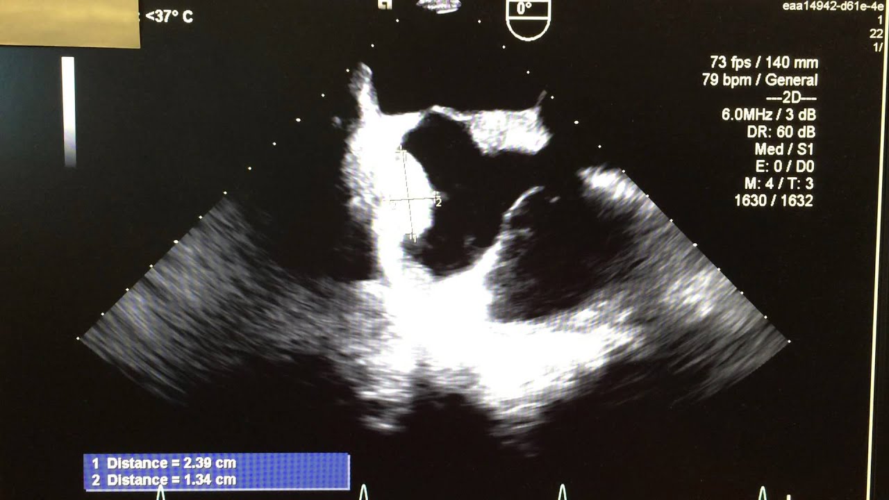 Echo Case 4 (Part 2)