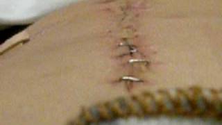 Abdominal Staple Removal