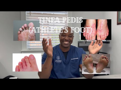 Everything About Tinea Pedis (Athlete’s Foot)! by Optimum Podiatry👣