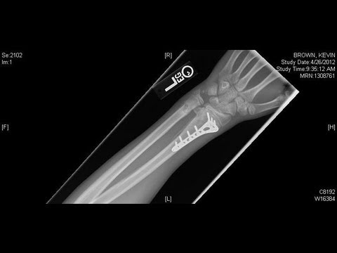 Broken Arm and Colar bone in Motocross Race