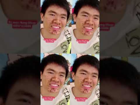 Kết Quả Trị Mụn Mủ Cho Hùng Ảo Thật… hihi | Phần 367 | Hang Oliver