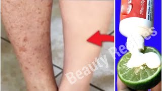 How to get rid of Dark spots, Scar, Mosquito Bites, Hyperpigmentation on legs fast.
