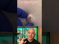 Doctor Reacts To MASSIVE Cyst Dermreacts Doctorreacts Pimplepop Cystpop