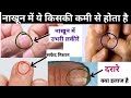 नाखून देखकर बीमारी का कारण जाने Nail Examination