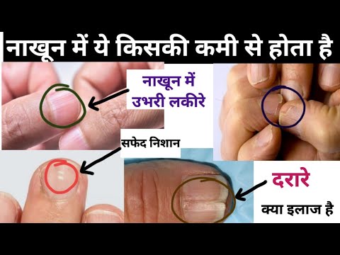 नाखून देखकर बीमारी का कारण जाने - Nail Examination