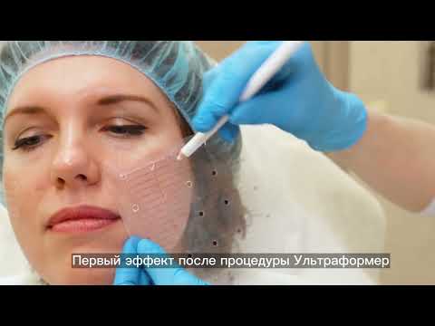 SMAS-лифтинг на аппарате Ультраформер