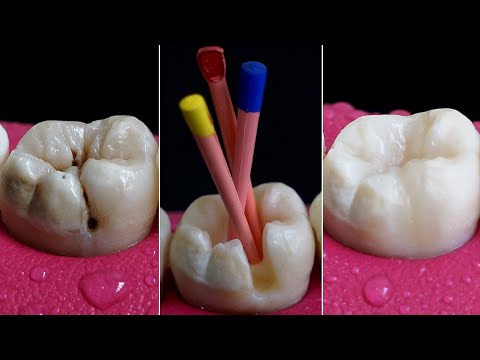 Restoration Of Carious Tooth | Root Canal Treatment