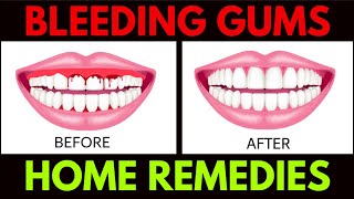 Bleeding Gums Home Remedies | Treat Your Bleeding Gums At Home