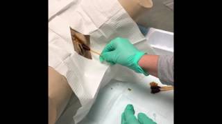 Sterile female straight catherization technique