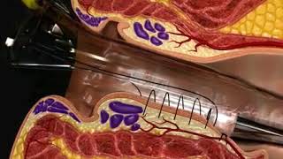 Cirugía de Hemorroides Sin Dolor THD