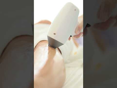 Painless Full-Body Laser Hair Removal with Soprano Ice by Alma