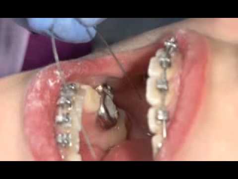 Advansync - Class II Molar to Molar: Part 2