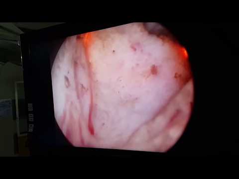 Metodi di trattamento del cancro alla prostata Quale migliore candele da recensioni prostatite
