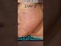 CO2 LASER DAY BY DAY Co2laser Acnescar Drgsmukherjee Acnescartreatment Dermatologist