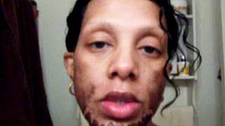 Jessner's Chemical Peel 30% with 20% Salicylic Acid on top- Morning 6