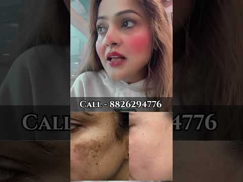 Skin care 8826294776#pigmentation #skincare #acne #antiaging #skin #beauty #glowingskin #melasma