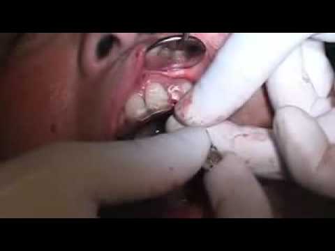 Colocacion de Implantes por Dr. Sorin Cristea 1