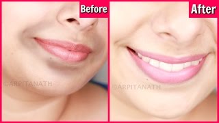 Remove Dark, Black Patches Around Mouth in 15 Minutes || Get Rid of Hyper-pigmentation