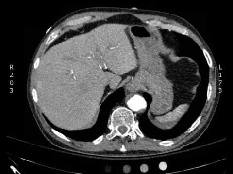 Ruptured AAA, axial CT. JETem 2017.