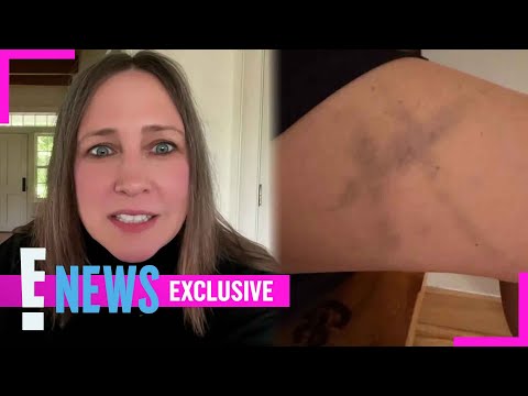 Vera Farmiga Details Eerie Bruise From The Conjuring: Last Rites Shoot | E! News