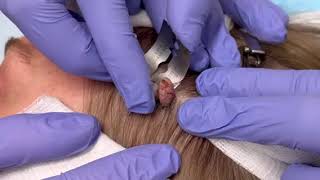 Dermatologist Removes Irritated Skin Lesion From Patient's Scalp