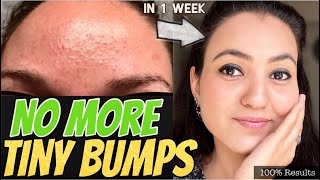 1 WEEK CHALLENGE 💕: GET RID OF TINY BUMPS NATURALLY in just 7 Days and Get Amazing EVEN SKINTONE