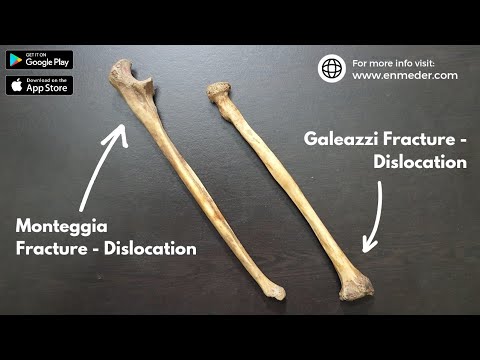 Monteggia and Galeazzi Fracture-Dislocation | Orthopedics | TCML