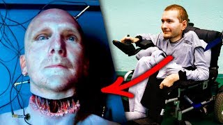 The First Human Head Transplant Was Successful? The truth - You Are Here