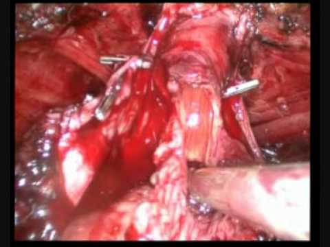 Laparoscopic Radical Prostatectomy