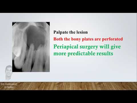 Large Periapical Lesion - Treatment Approach