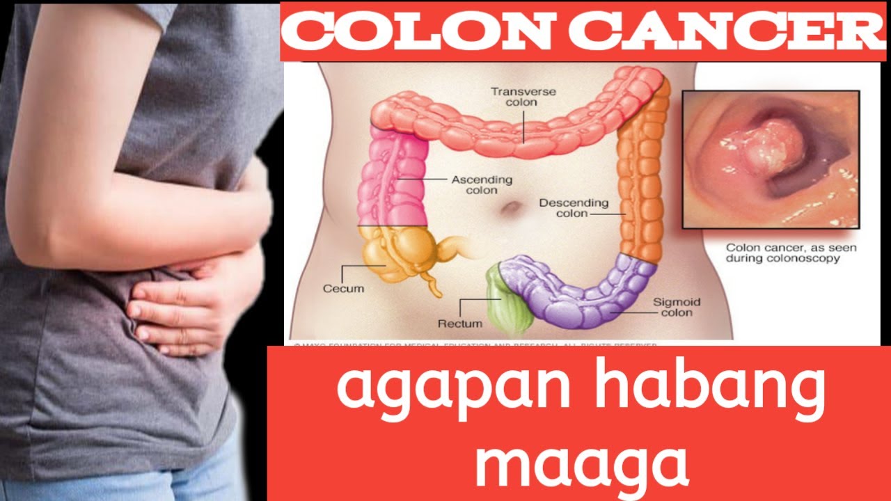 Putar video Signs and Symptoms of colon cancer | Health Tips #shorts sekarang Signs and Symptoms of colon cancer | Health Tips #shorts