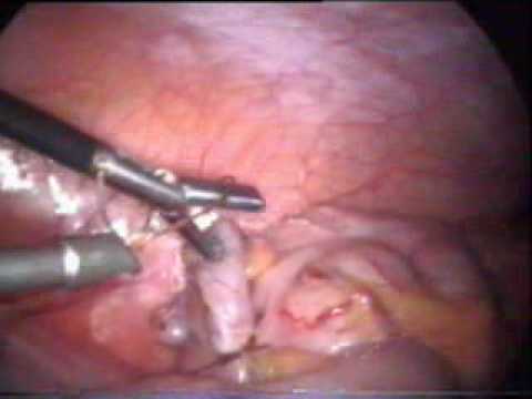 Laparoscopic appendicectomy