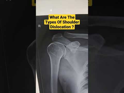 What Are The Types Of Shoulder Dislocation ? Dr Sai Chandra MBBS DNB Ortho