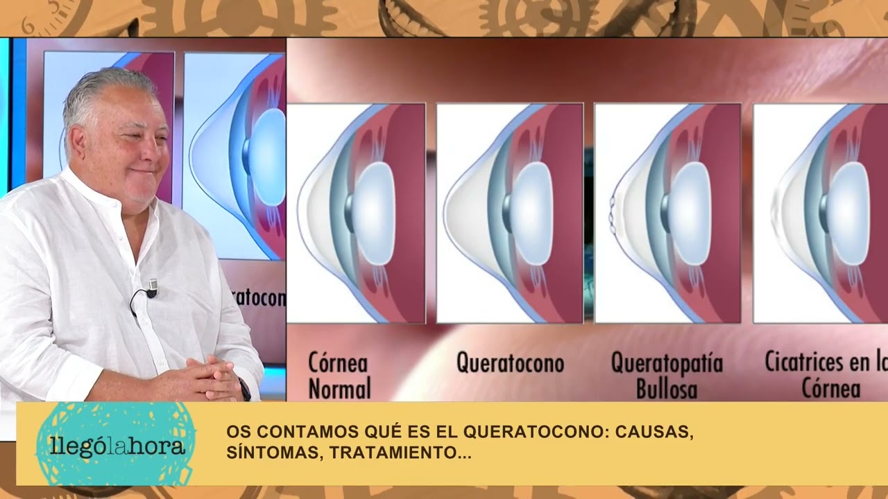 🔹 "Queratocono: Síntomas, Causas y Tratamientos Explicados"