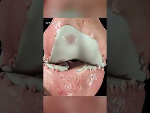 See What Arthritis Actually Does to a Knee Joint #shorts