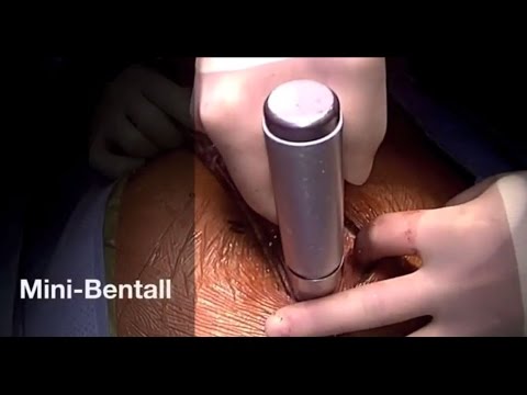 Mini-Bentall Procedure