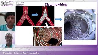 SINERGY 2020 - Bifurcation PCI: lessons from bench testing - TAP stenting
