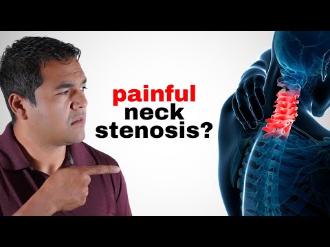 10 Things You Should AVOID if You Have Neck Cervical Stenosis