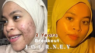 PRESCRIPTION DOXYCYCLINE. 2 TAHUN BREAKOUT, AND NOW I HAVE THE TIPS FOR ALL ACNE FIGHTER !!| 2021