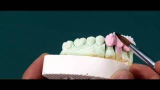 Prothèse fixe - Montage céramique  [ CCM - GouriDENT ]